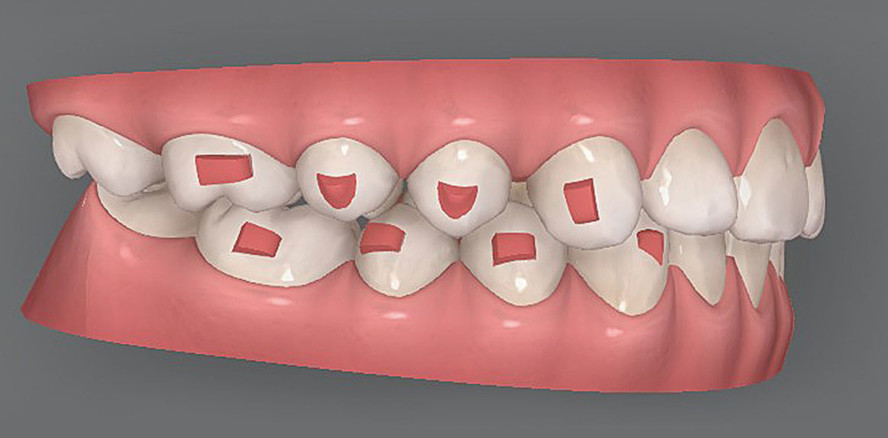 Aligner Attachments: Effizient hergestellt