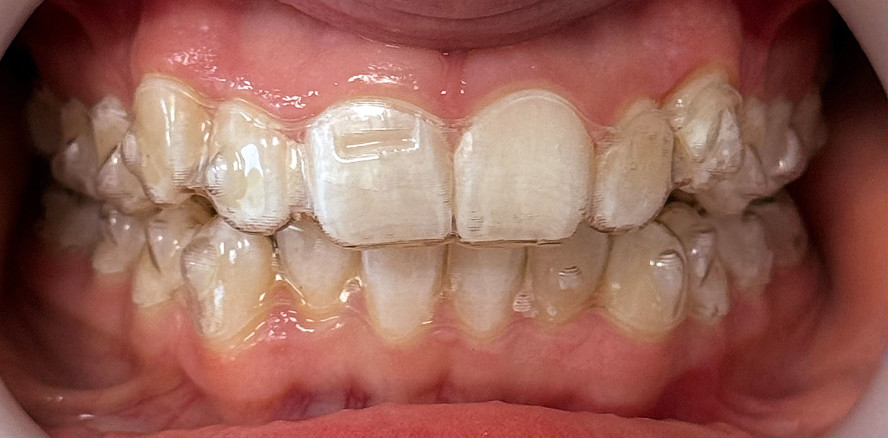 Aligner bei Kindern und Jugendlichen – wissenschaftliche Evidenz im Wachstumsvorteil