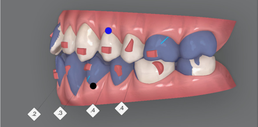 Digitale Behandlungsplanung bei Klasse III mit frontalen Engständen