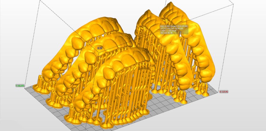 Nächste Generation: Direkt 3D-gedruckte Aligner
