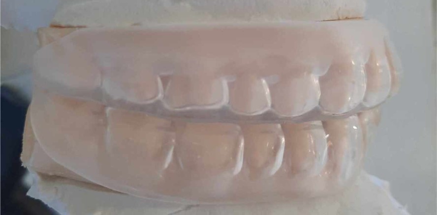 Aligner und myofunktionelle Therapie (MFT)