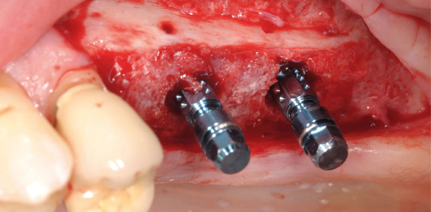 Alternative zum klassischen Knochenblocktransplantat