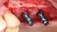 Alternative zum klassischen Knochenblocktransplantat