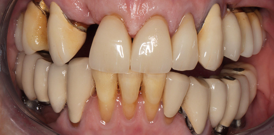 Altersspezifische Aspekte in der Implantatversorgung bei Senioren