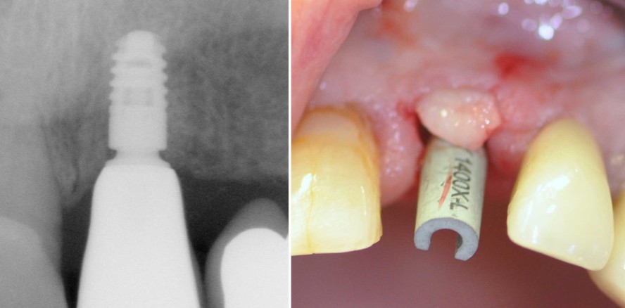Anwendung der minimalinvasiven Socket Seal-Technik