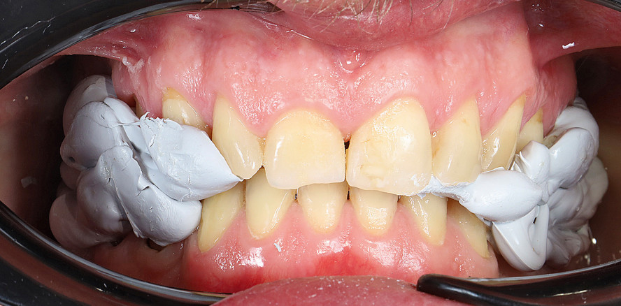 Bisshebung mit palatinalen Veneers: digitale Umsetzung und Planung