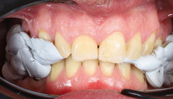 Bisshebung mit palatinalen Veneers: digitale Umsetzung und Planung
