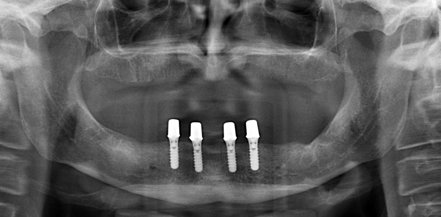 Präfabrizierte Attachments für Implantatversorgungen