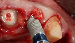 Augmentation mit partikelförmigem Dentin im Oberkiefer
