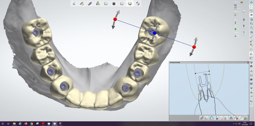 Von der Restauration zum Implantat – Zahntechnik mal andersherum