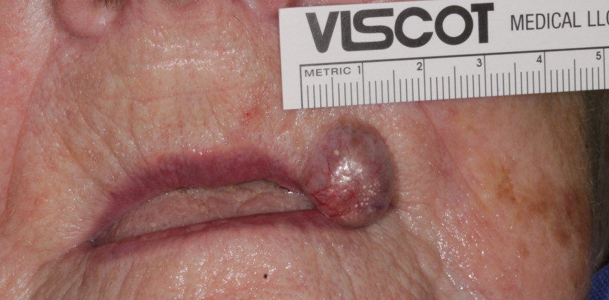 Basalzellkarzinome an der Grenze von Lippenrot und Lippenweiß