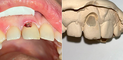 Zur Behandlung einer ausgeprägten zervikalen Resorption mit ästhetischem Outcome