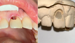 Zur Behandlung einer ausgeprägten zervikalen Resorption mit ästhetischem Outcome