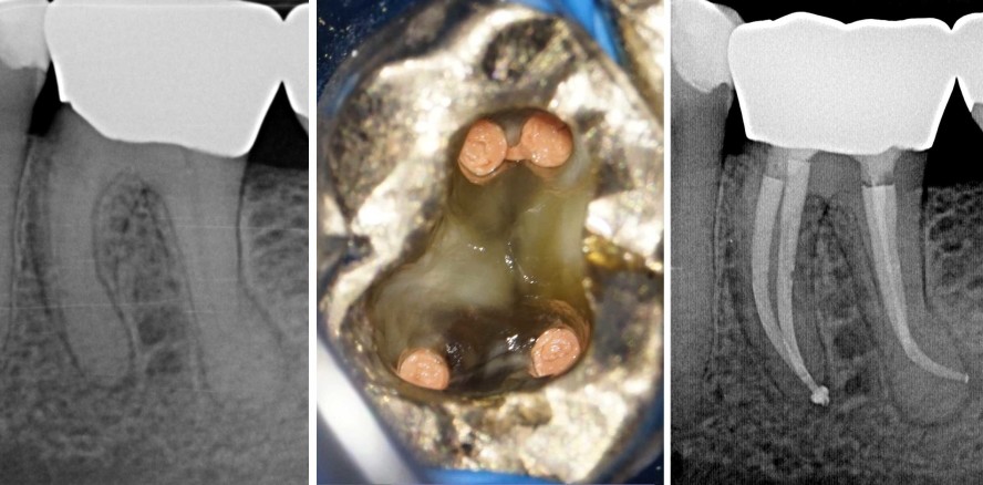 Behandlung eines unteren Molaren mit Obliteration des mesiolingualen Kanals
