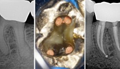 Behandlung eines unteren Molaren mit Obliteration des mesiolingualen Kanals