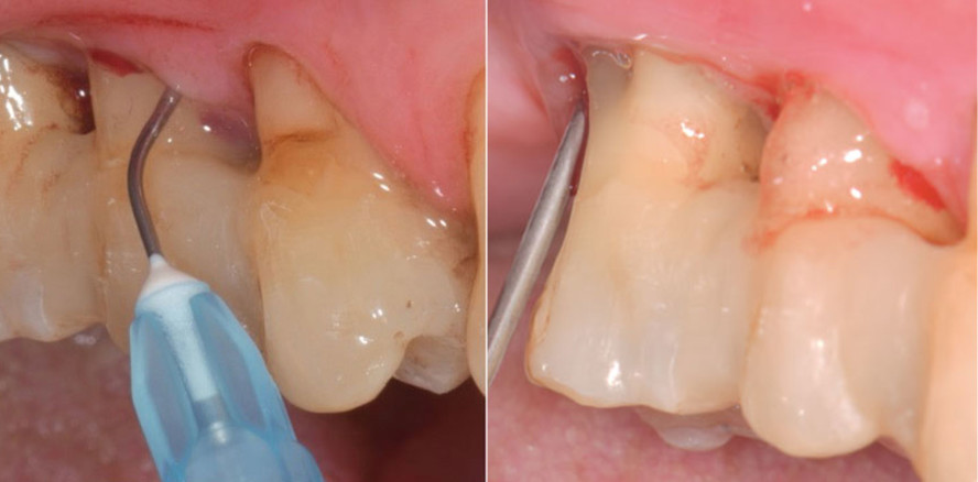 Behandlung von residualen Parodontaltaschen und Periimplantitis
