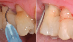 Behandlung von residualen Parodontaltaschen und Periimplantitis