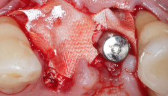 Erfolgreiche Behandlung eines Periimplantitisdefekts