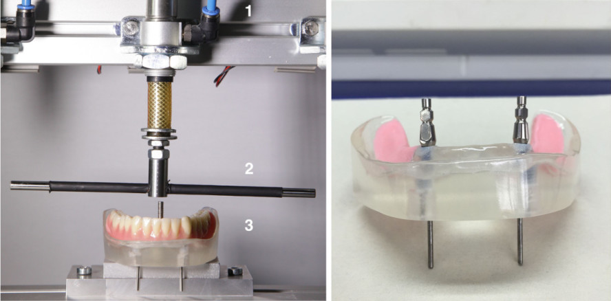 Belastungsausgleich bei implantatgelagerten Freiendprothesen