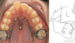 Distalisierung mit dem Beneslider – ein Update