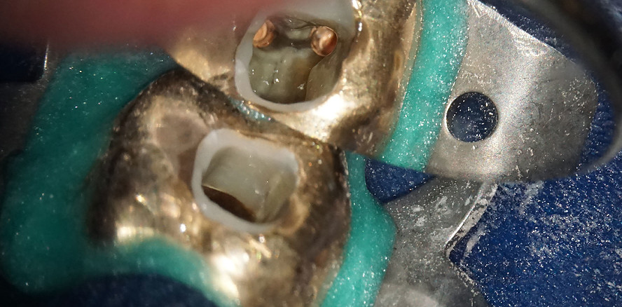 Bildgebende Begleitung der endodontischen Therapie mit DVT