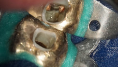 Bildgebende Begleitung der endodontischen Therapie mit DVT