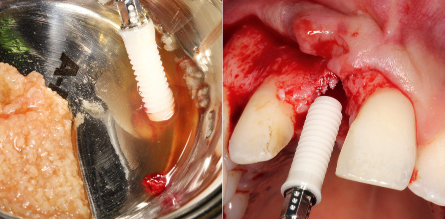 Einzelzahnversorgung mit Keramikimplantat nach Trauma