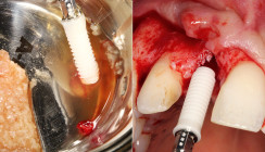 Einzelzahnversorgung mit Keramikimplantat nach Trauma