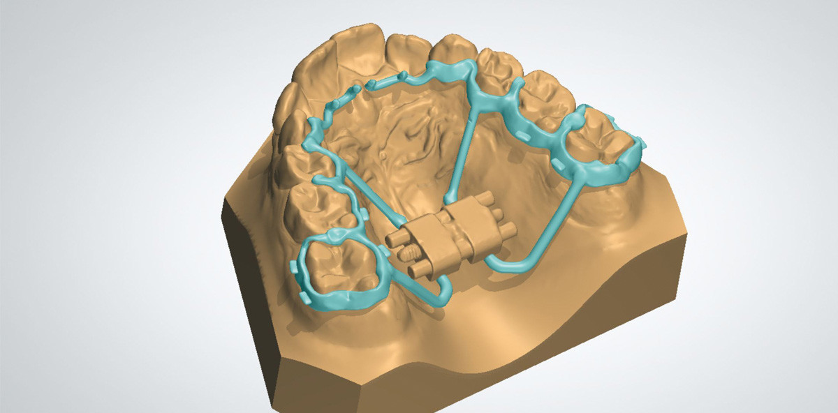 CAD/CAM im klinischen kieferorthopädischen Alltag