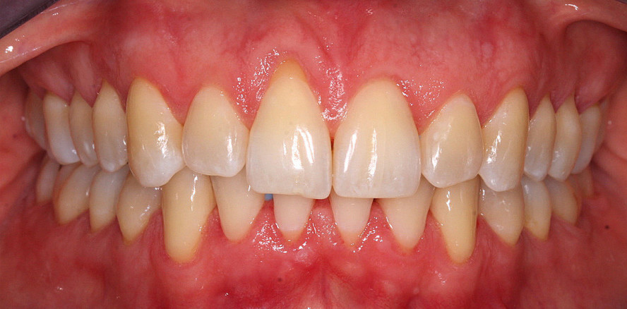 Kieferorthopädisch-parodontologische Kombinationstherapie