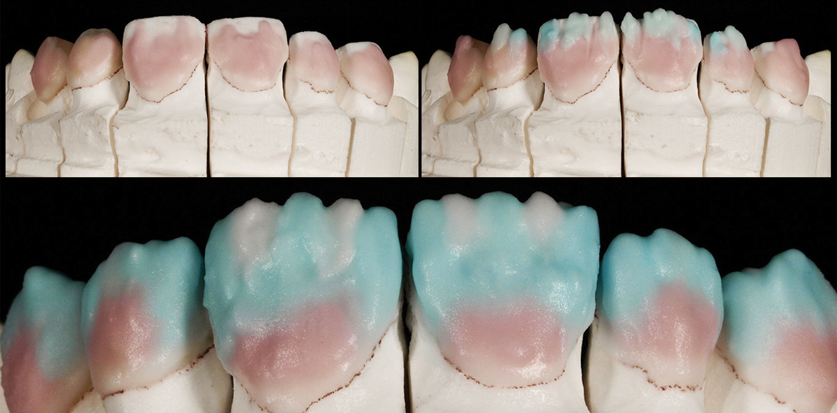 Veneers – Ein Plädoyer für die Handarbeit