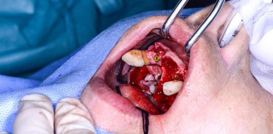 Komplexe Rekonstruktion im parodontal kompromittierten Gebiss