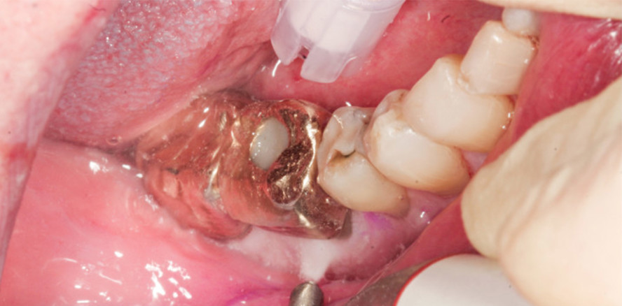 Mehrwurzelige Zähne in der UPT