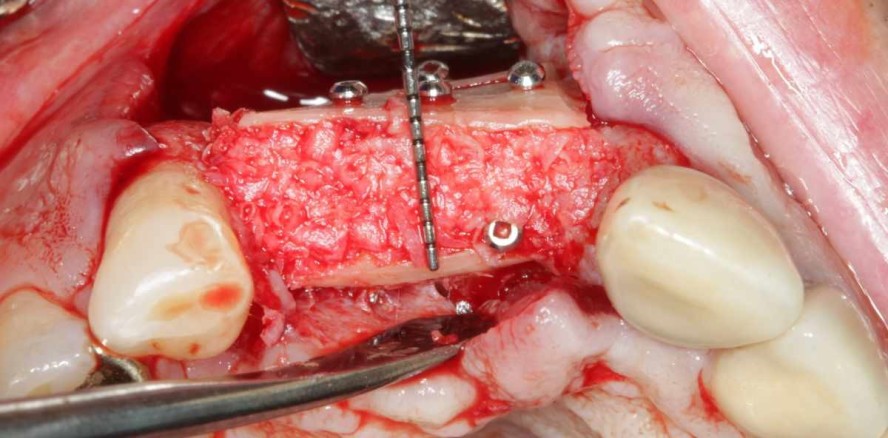 Die chirurgische Behandlung der Periimplantitis