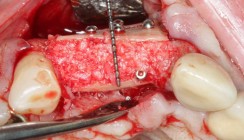 Die chirurgische Behandlung der Periimplantitis