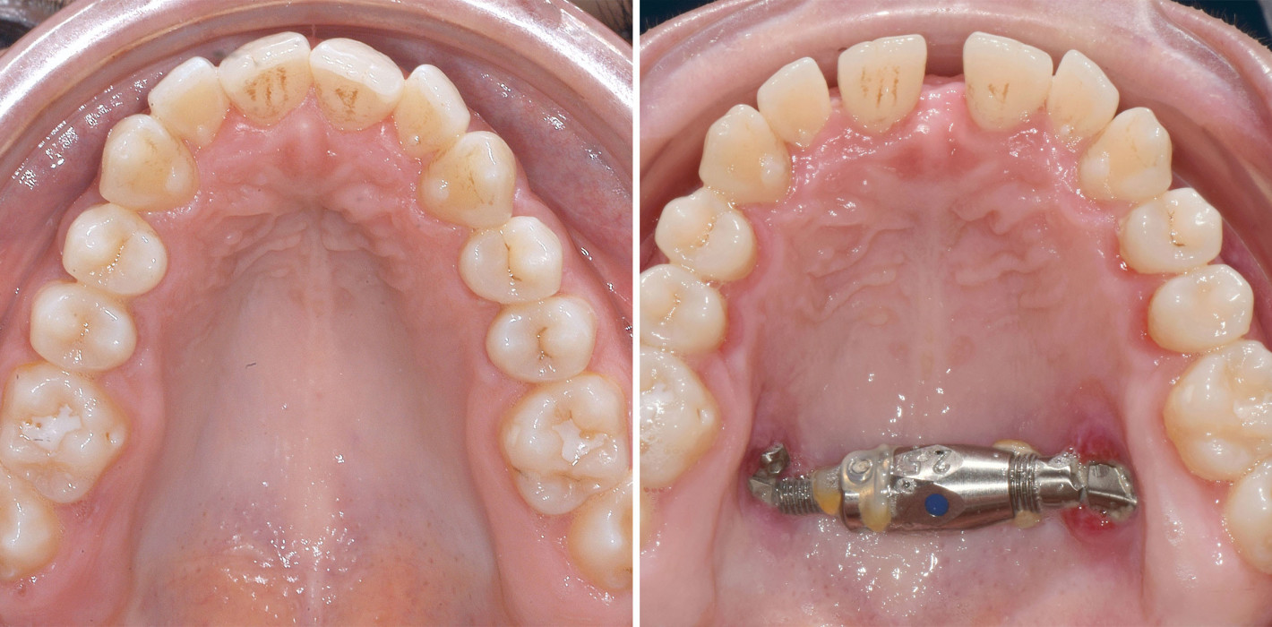 Gaumennahterweiterung oder dentoalveoläre Kompensation?