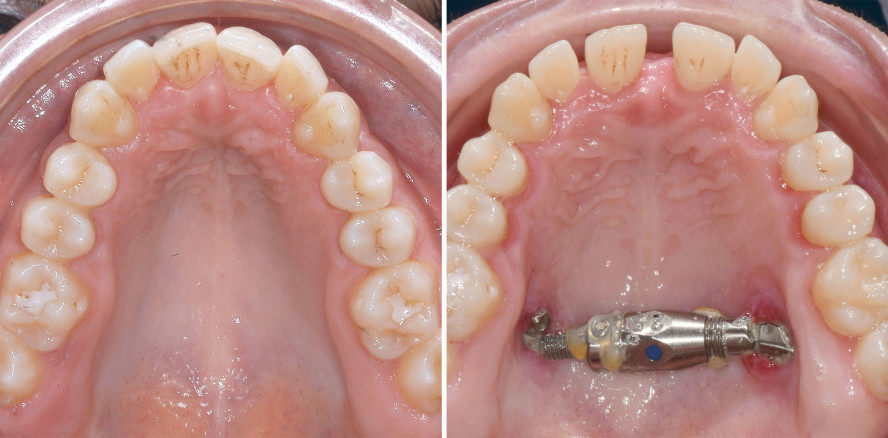 Gaumennahterweiterung oder dentoalveoläre Kompensation?