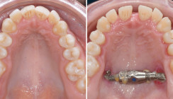 Gaumennahterweiterung oder dentoalveoläre Kompensation?