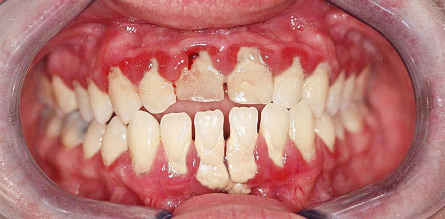 Chlorhexidin-Lösungen in der heutigen Parodontitistherapie