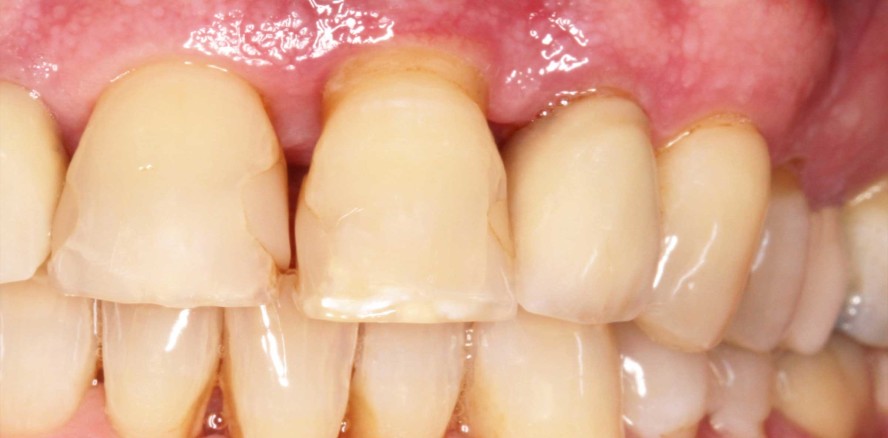 Clean & Seal-Konzept: Behandlung tiefer Parodontaltaschen