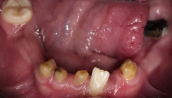 Cleidokraniale Dysplasie als interdisziplinäre Herausforderung der Kieferorthopädie