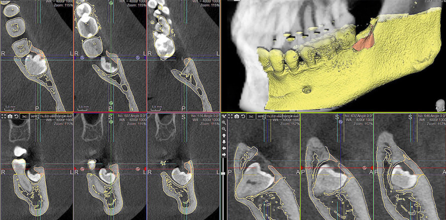 Die geführte Exodontie unter endoskopischer Visualisierung
