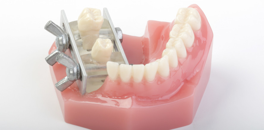 Signifikante Reduktion iatrogener Schäden an Nachbarzähnen