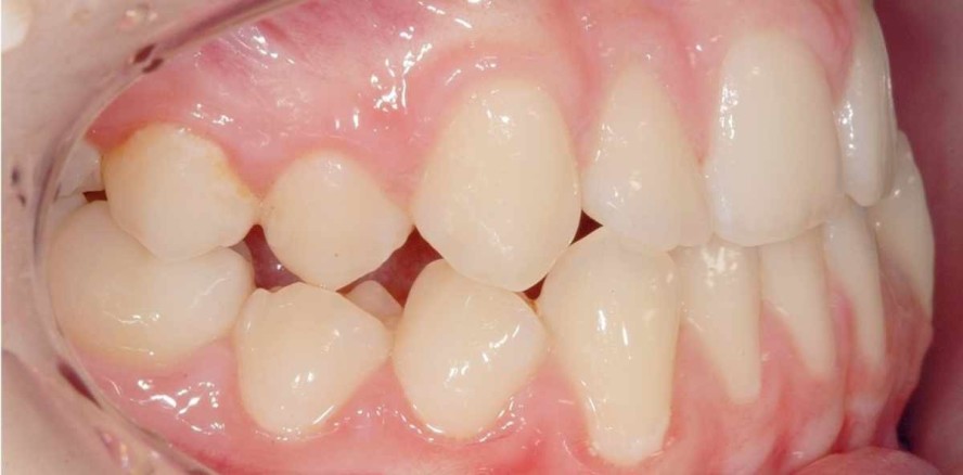 Dentoalveoläre Kompensation bei Klasse III-Malokklusion mit Lingualtechnik