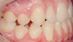 Dentoalveoläre Kompensation bei Klasse III-Malokklusion mit Lingualtechnik