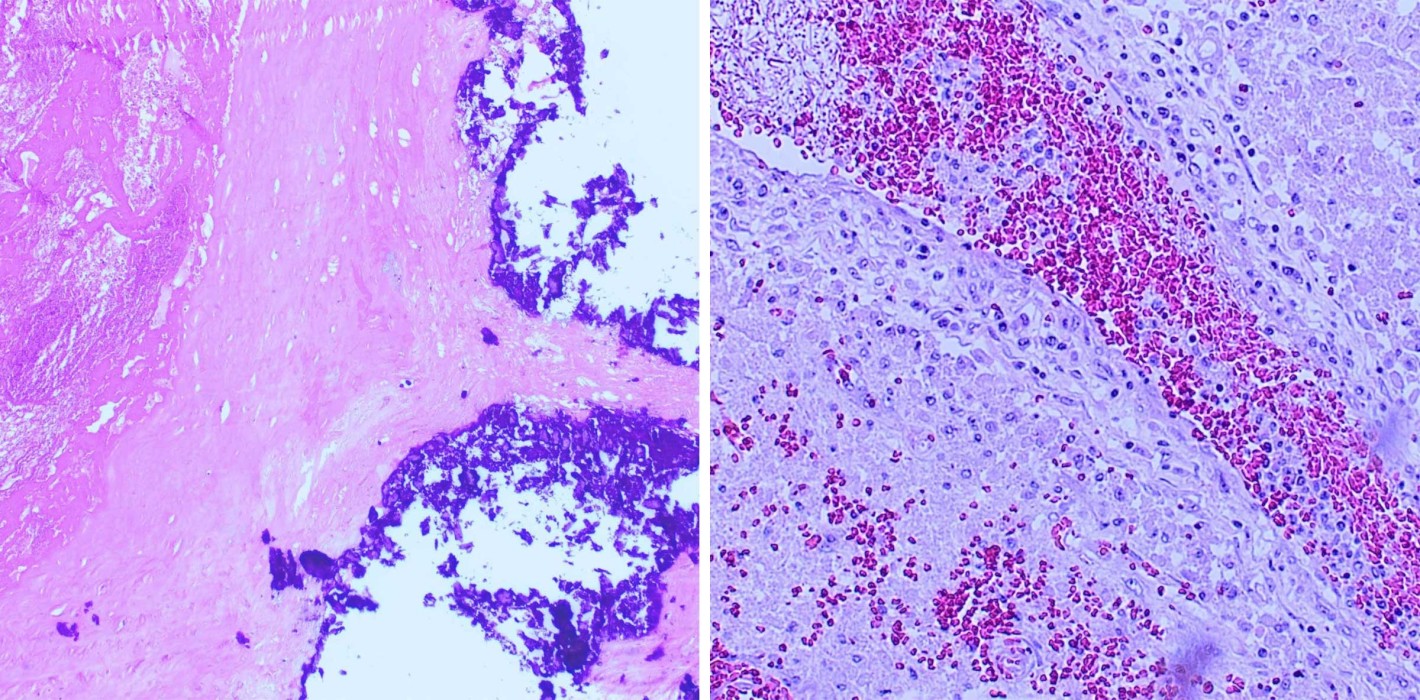 Dentogene Bakteriämie: Syste­mische Pathogenität oraler Biofilme