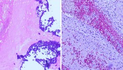 Dentogene Bakteriämie: Syste­mische Pathogenität oraler Biofilme