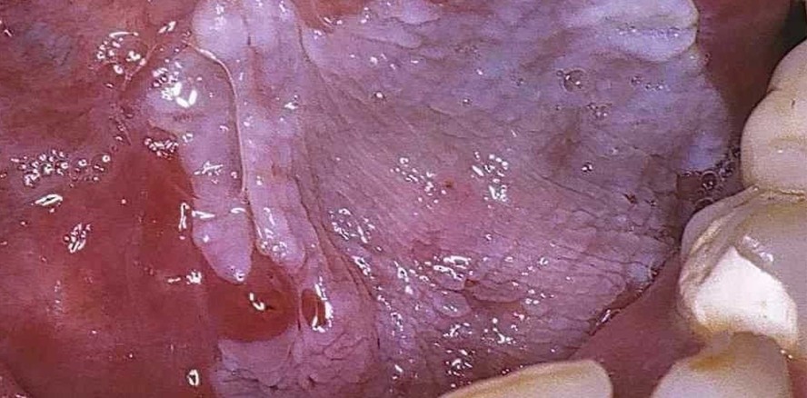 Der Speichel als Spiegelbild oraler und systemischer Erkrankungen