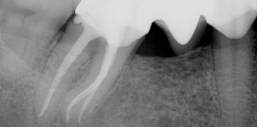 Desinfektionslösungen in der endodontischen Praxis