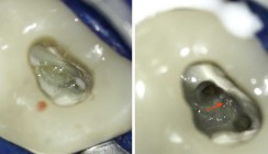 Die endodontische Zugangskavität: Übersicht anatomischer Strukturen
